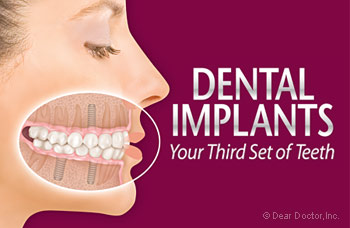Dental implants - your third set of teeth.