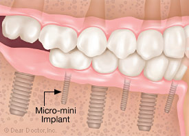 Micro-mini dental implants.