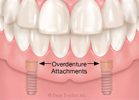 Overdenture.