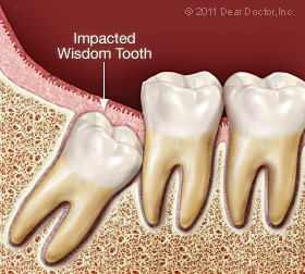 Impacted wisdom tooth.