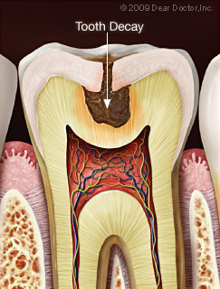 Tooth decay.