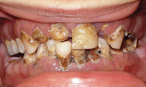 Diet soda abuser mouth.