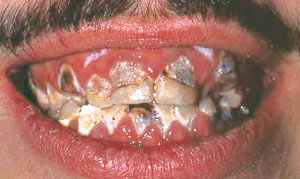 Methamphetamine users mouth.