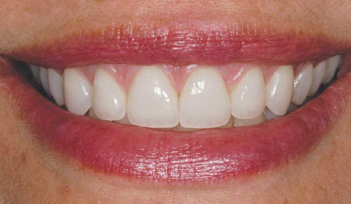 After Veneers.