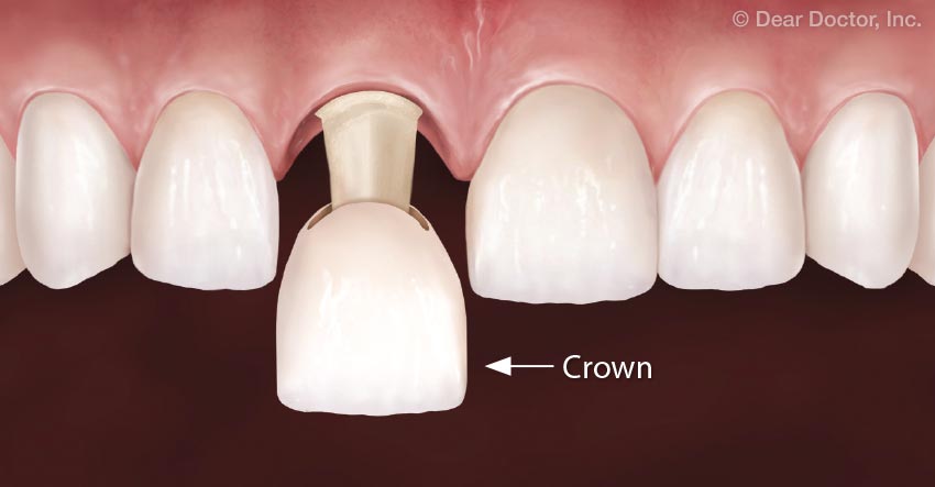 Dental Crown.