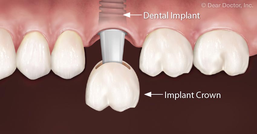 Dental Implant.