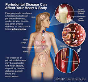 Periodontal Disease Chart.