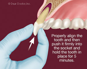 Replanting a tooth after a dental injury.