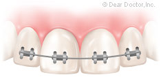 Splinting teeth.