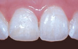 Repairing a chipped tooth with bonding.