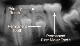 X-ray of primary tooth.