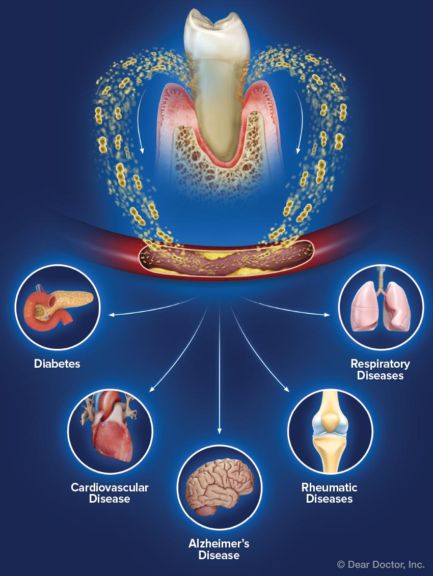 Gum disease and systemic health.