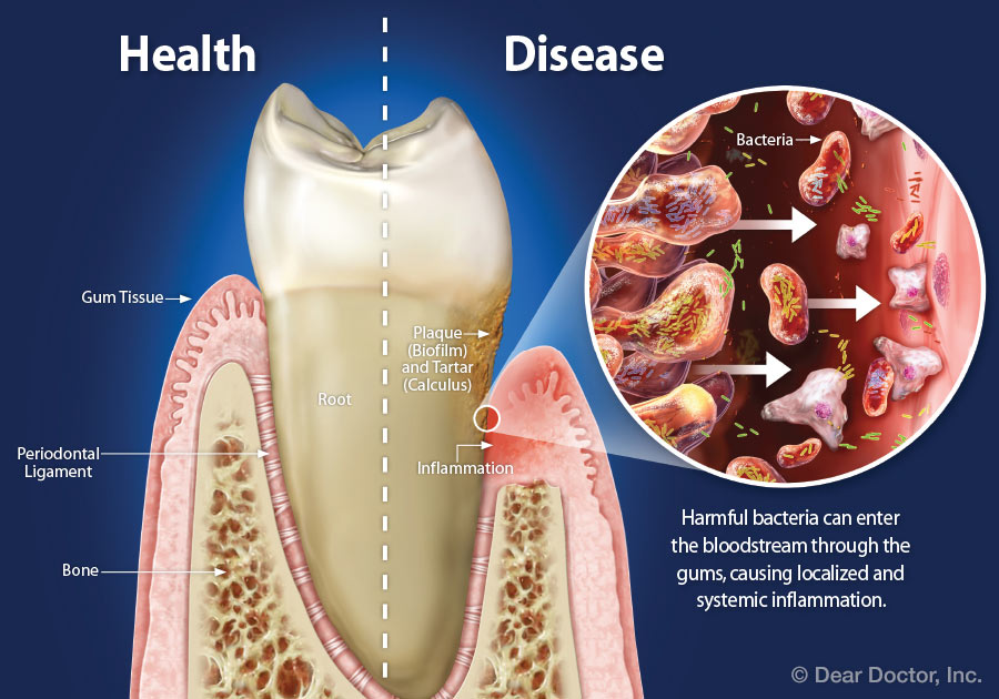 Gum Disease And Systemic Health