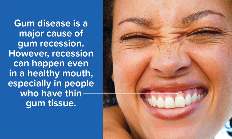 Gum Recession