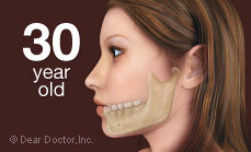 Bone loss in 30 year old when teeth are not replaced.