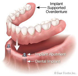 Dental implant supported overdenture.
