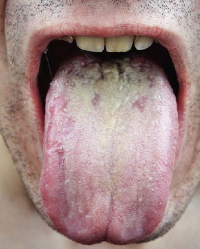 hiv symptoms mouth