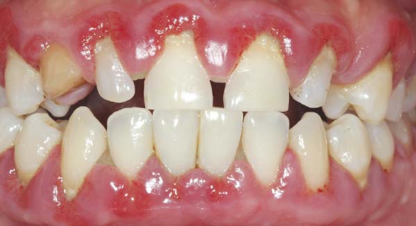 Periodontal (gum) disease is a risk for hiv-postive individuals.
