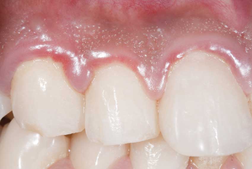 Puffy reddened gums.