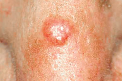 Basal cell carcinoma.