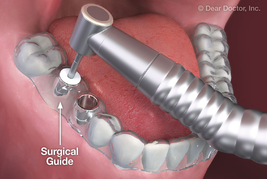 Dental implant surgical guide.