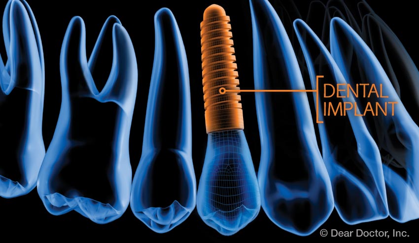 Dental implant technology.