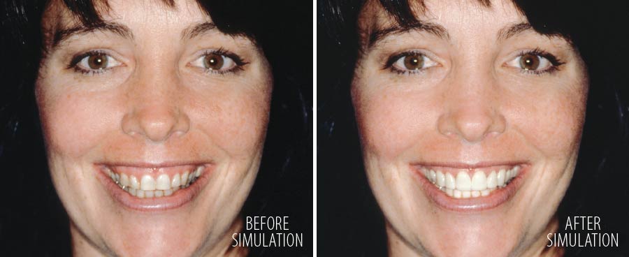 Computer simulation of smile makeover.