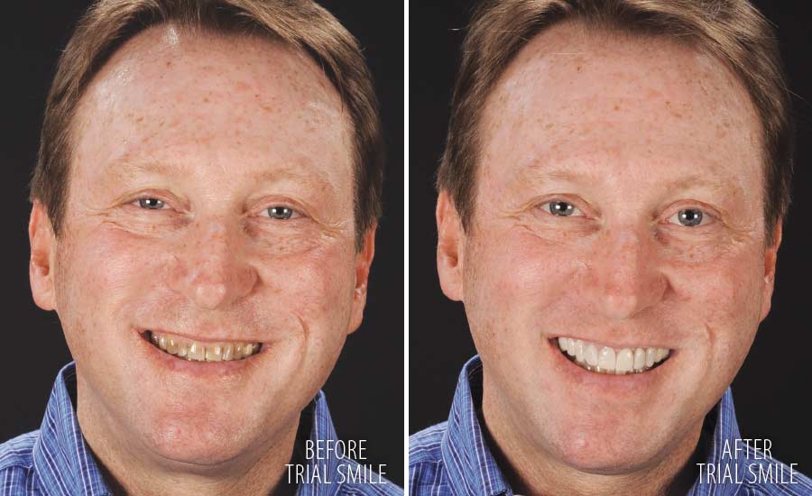 Trial smile makeover.