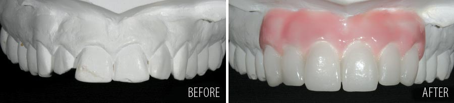 Wax-up of smile makeover.