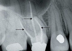 Root canal x-ray.