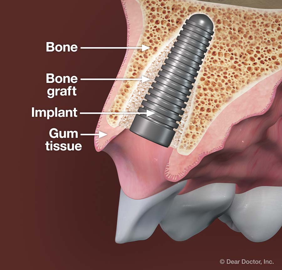 Bone graft - dental implant.