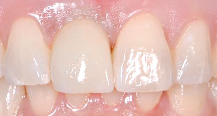 Immediate implant - after treatment.