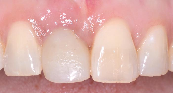 Immediate implant - temporary crown.