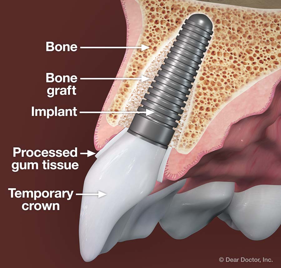 Processed gum tissue - dental implant.