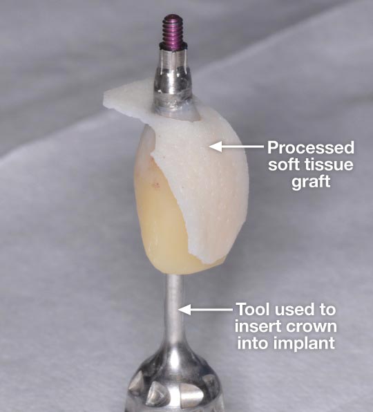 Processed soft tissue graft.