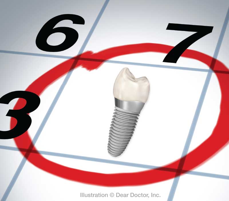 Dental Implant Timelines For Replacing Missing Teeth.