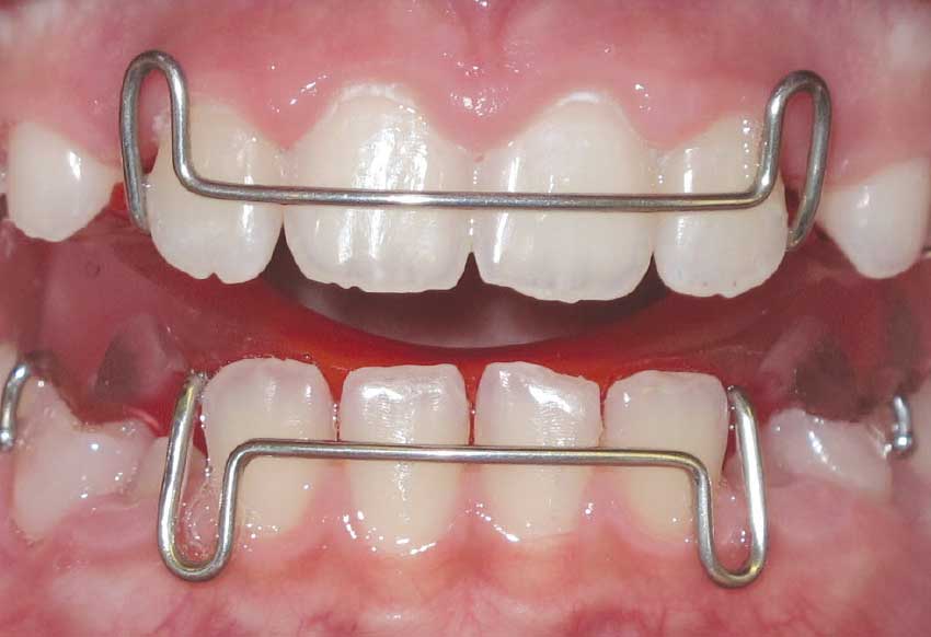 Palatal expander elülső.