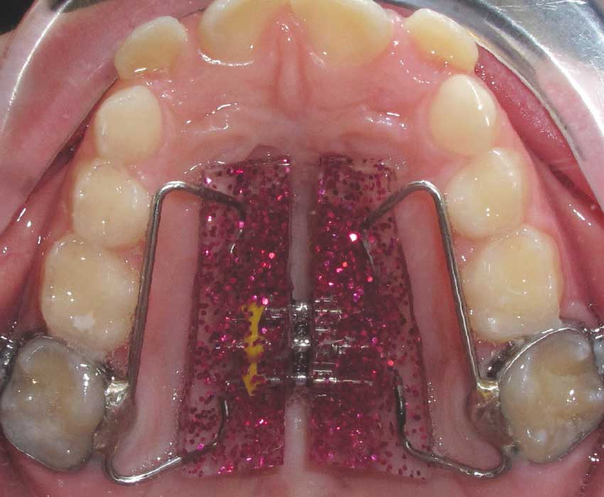 Palatal expander top.