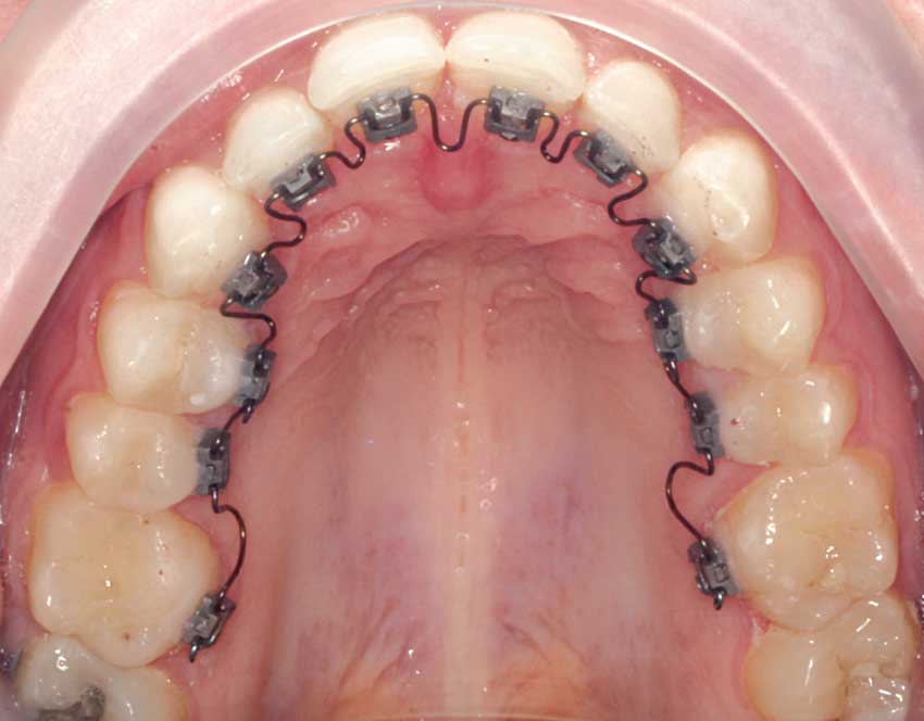 Lingual braces brackets bonded to teeth.