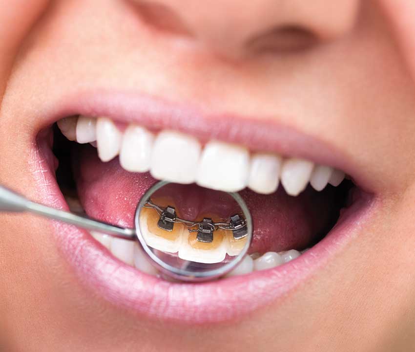 Lingual Braces An Invisible Way To Straighten Teeth
