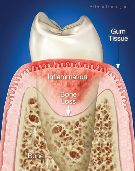 Inflammatory periodontal disease