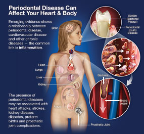 Periodontal Disease Can Affect Your Heart And Body.