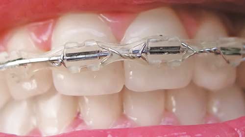 Orthodontic elastics.