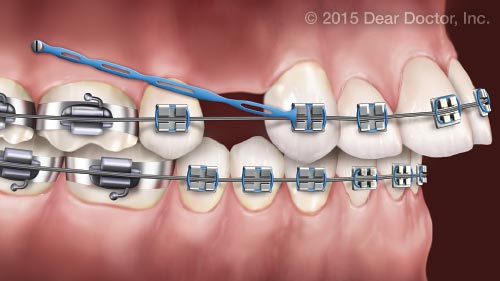 Orthodontic Headgear, Gerken Orthodontics