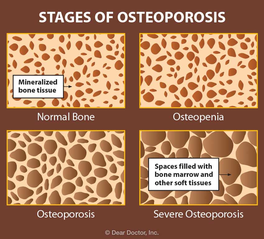 Stages of Osteoporosis.