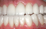 Final restoration using veneers and crowns.