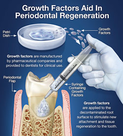 Growth Factors Aid In Periodontal Regeneration