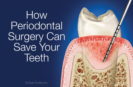 Periodontal flap surgery.