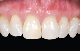 After periodontal plastic surgery.