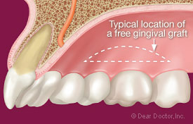 Typical location of a free gingival graft.